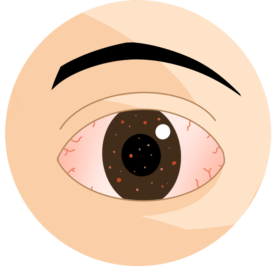 ecd_conjunctivitis_type