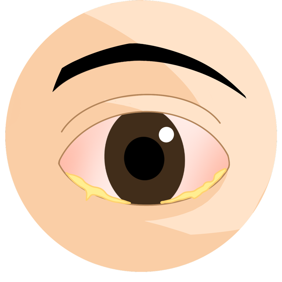 ecd_conjunctivitis_type
