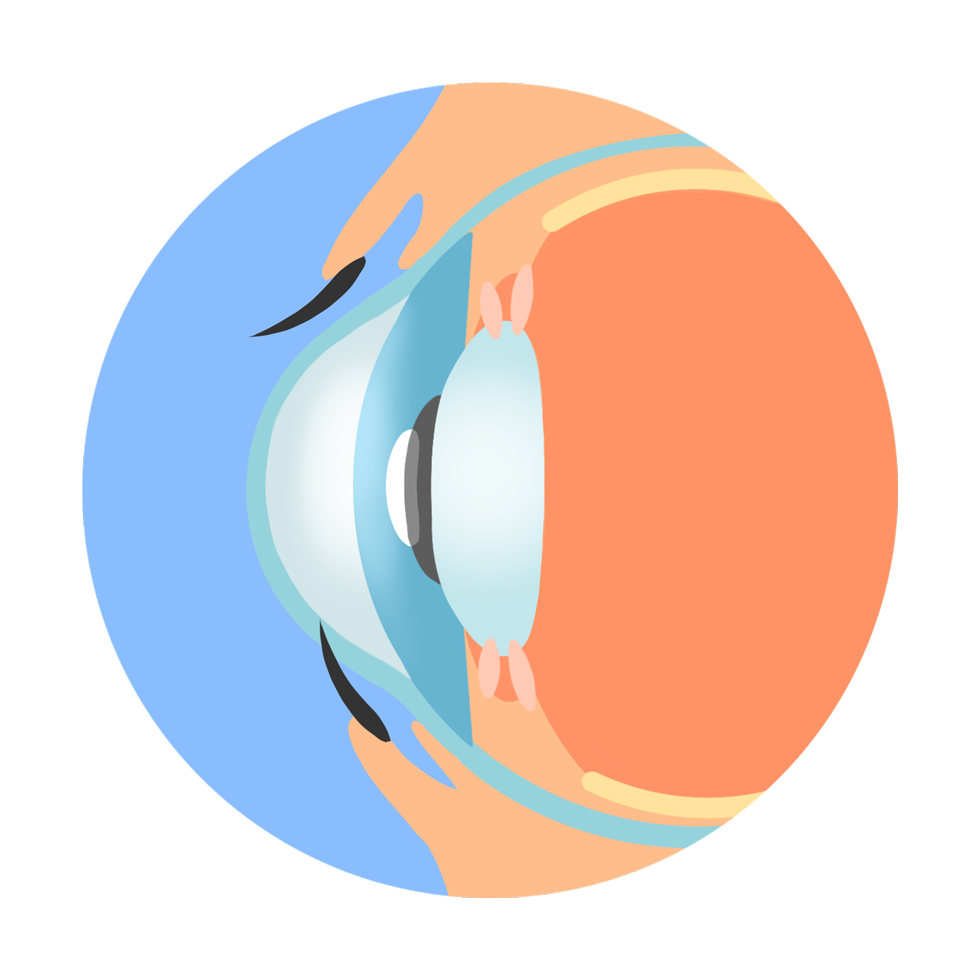 ecd_distichiasis_know