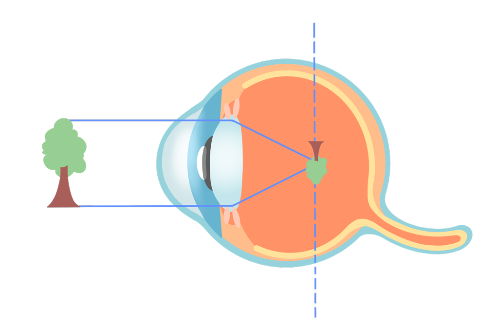 ecd_nearsighted_type