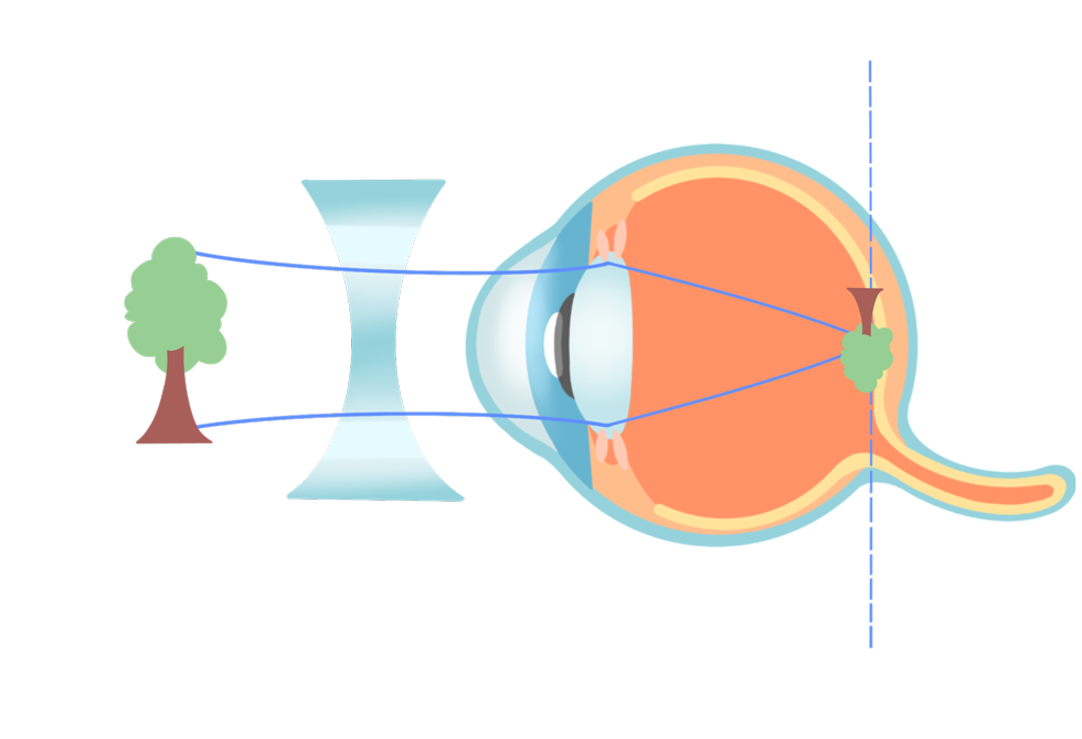 ecd_nearsighted_type
