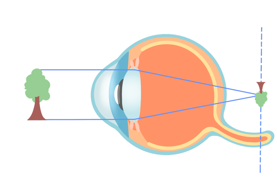 ecd_nearsighted_type