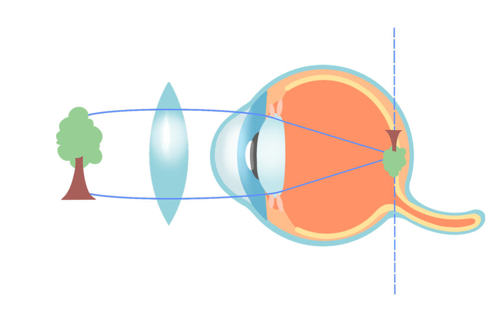 ecd_nearsighted_type