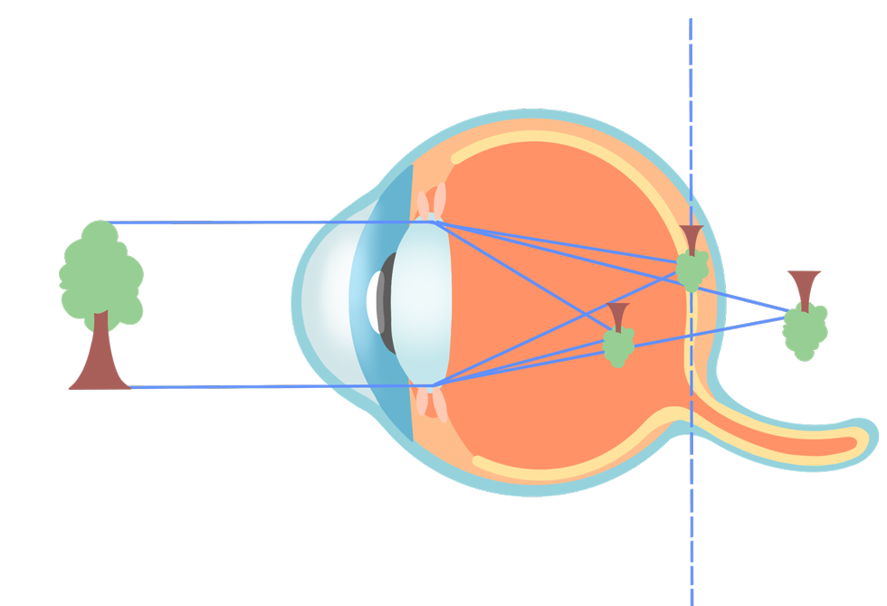 ecd_nearsighted_type