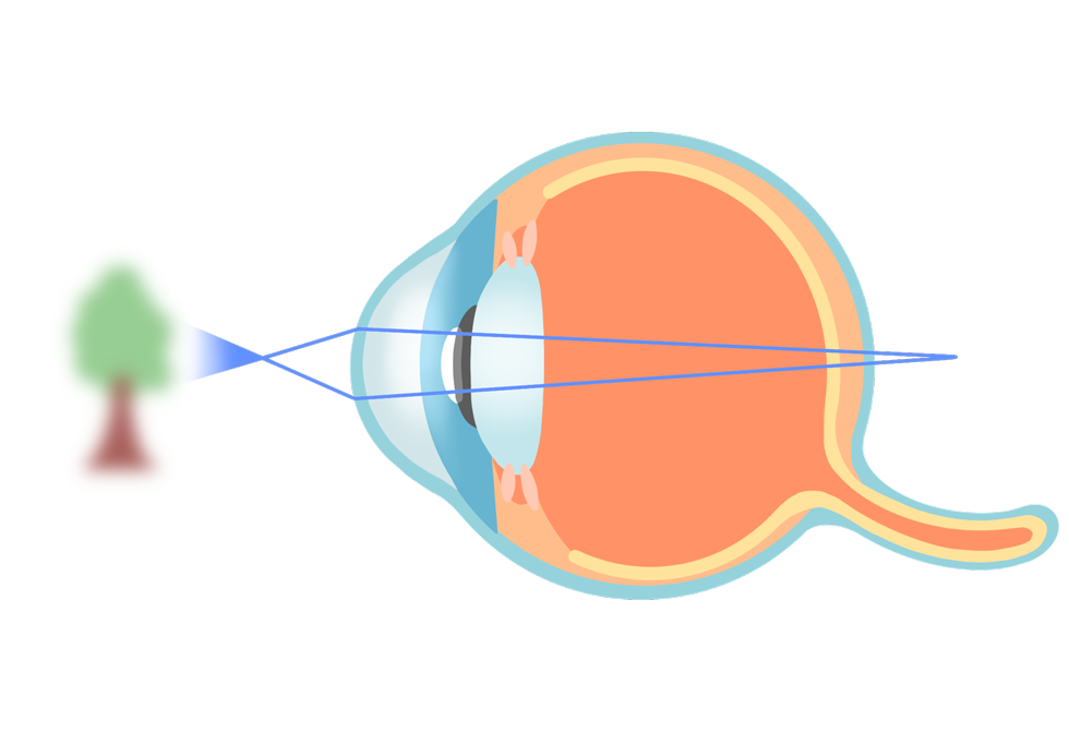 ecd_presbyopia_type