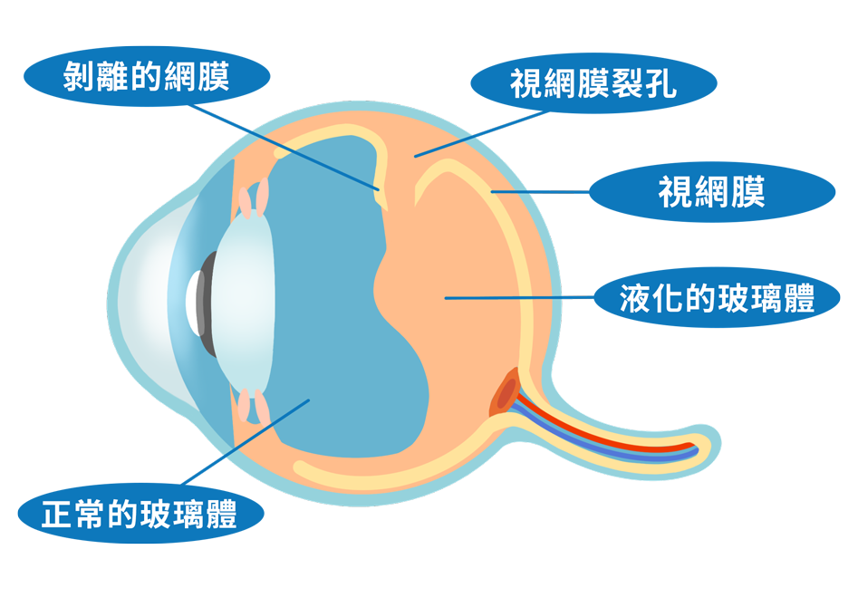 視網膜剝離|DR.EYE