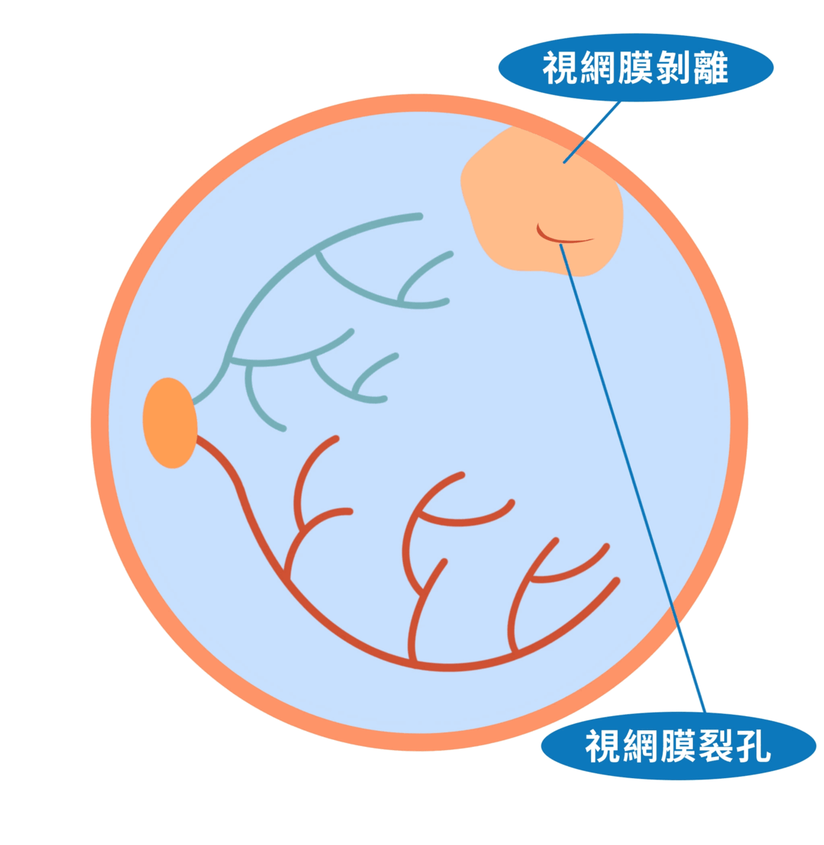 ecd_retinal_detachment_type