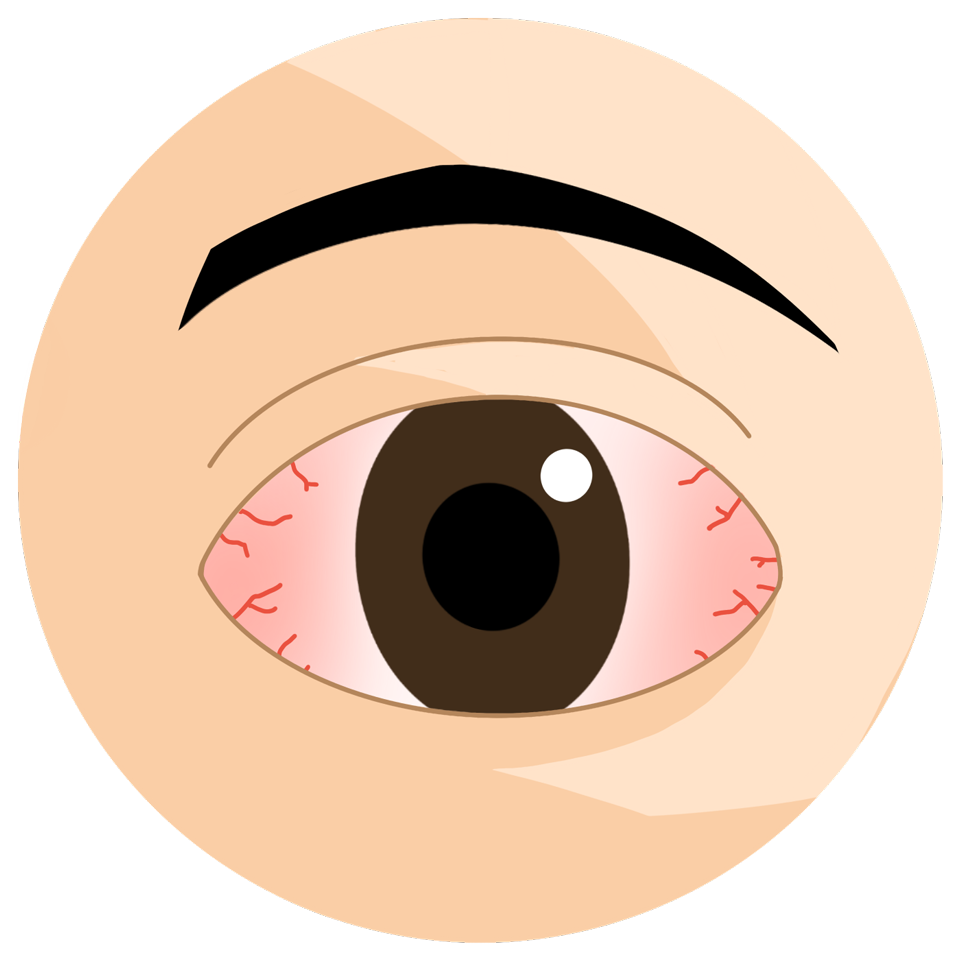 ecd_subconjunctival_hemorrhage_type